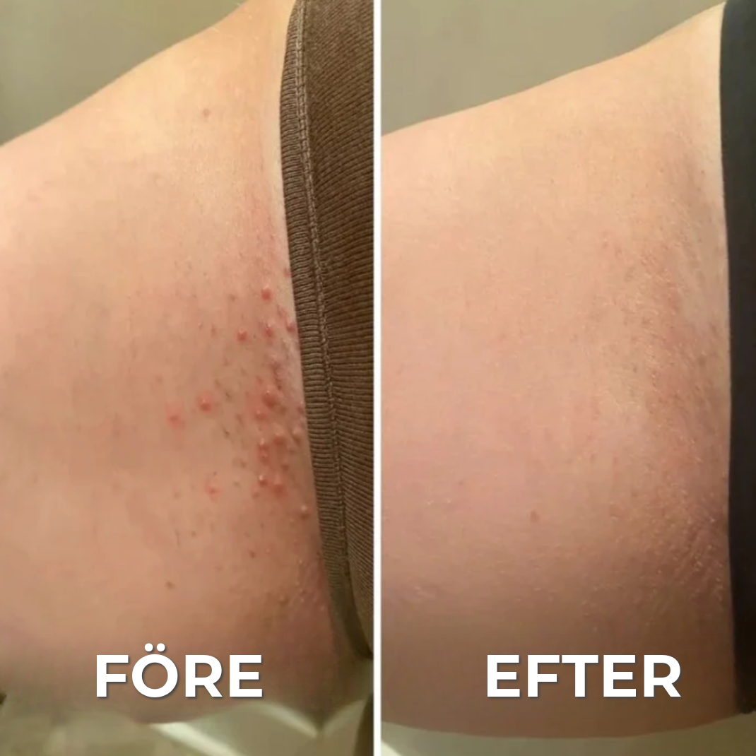 Proffsig Epileringsmaskin