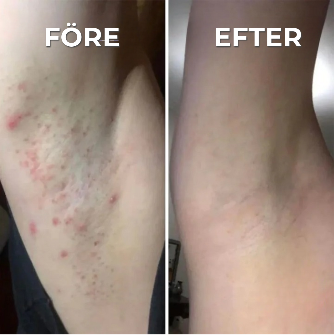Proffsig Epileringsmaskin